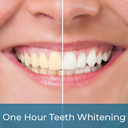 Fast, effective, and safe teeth whitening in Mira Road.